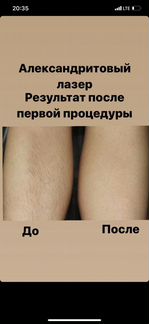Лазерная эпиляция